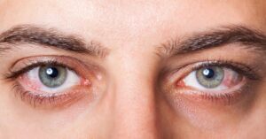 Dry Eyes? Here’s What Causes It and How to Treat It
